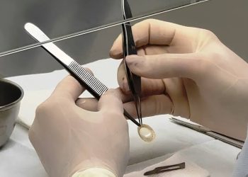 Banco de Olhos garante qualidade dos tecidos oculares doados em SC